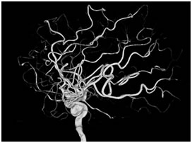 3D cerebral angiogram showing aneurysm - Dr Jonathan Curtis MBBS, FRACS, Neurosurgeon