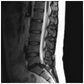Acute Disc Prolapse - Dr Jonathan Curtis MBBS, FRACS, Neurosurgeon
