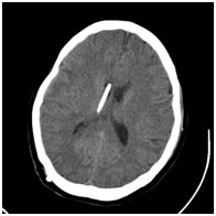 Ventriculoperitoneal Shunt placed for "hydrocephalus"
