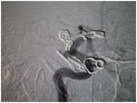 Recurrent aneurysm seen near clips - Dr Jonathan Curtis MBBS, FRACS, Neurosurgeon