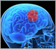 Brain Conditions - Dr Jonathan Curtis MBBS, FRACS, Neurosurgeon